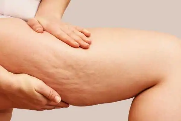 Image of woman showing leg with cellulite Christchurch