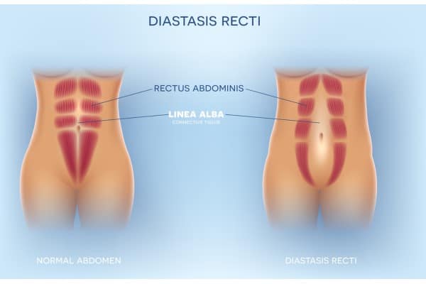 What Non-Surgical Options Are Available for Diastasis Recti Christchurch?