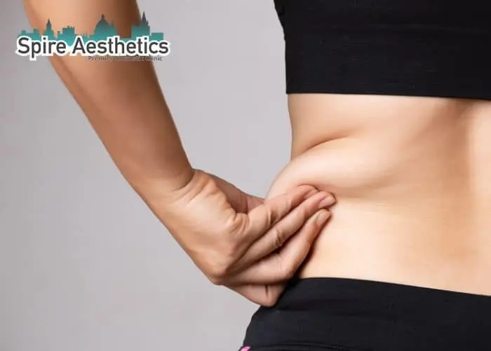 Image of woman pinching fat on their hips Christchurch. Fat Freezing treatment