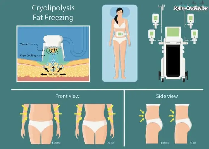 Fat freezing treatment Christchurch benefits for competitions to remove stubborn fat deposits.