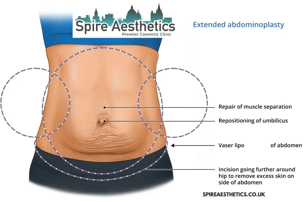 Understanding Loose Skin After Gastric Band Christchurch Surgery and HIFU Treatment
