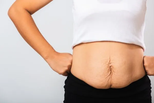 Image of a woman's stomach after weight loss with sagging skin following a gastric band Christchurch