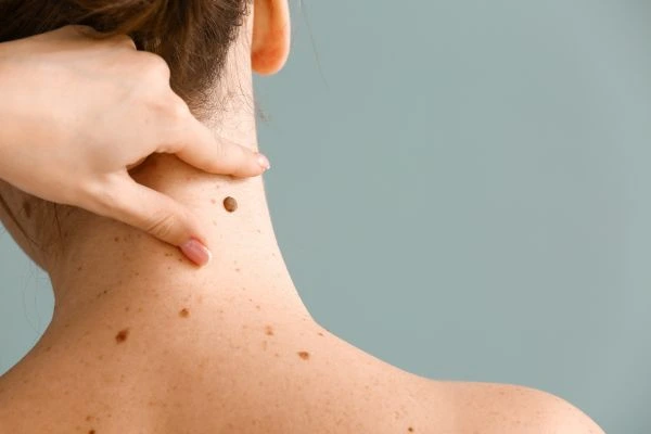 skin blemish removal Christchurch treatment
