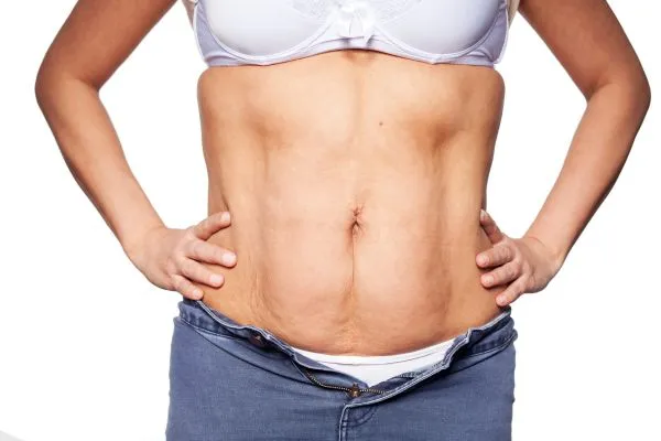 sagging skin on woman's stomach after weight loss injections Christchurch