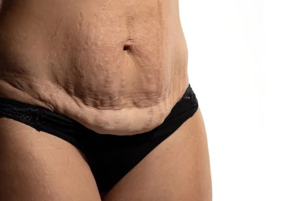 Image of womans stomach after weight loss injections Christchurch showing saggy skin