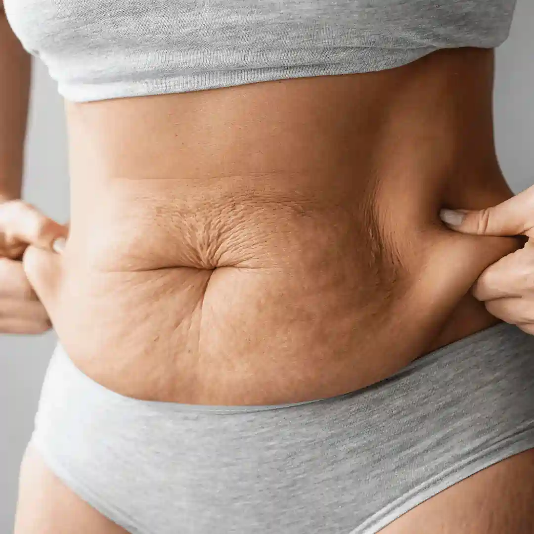 Is It Normal to Have Loose Skin After Pregnancy Christchurch?